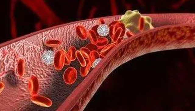 深靜脈血栓防治之流水不腐，戶(hù)樞不蠹