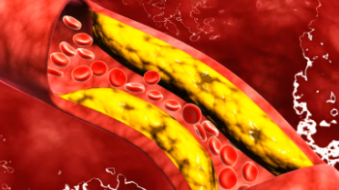 年度回眸、精彩擷萃丨2022年靜脈血栓防治領域十件大事