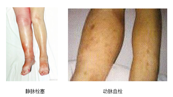 動脈血栓和靜脈血栓有什么區(qū)別嗎？