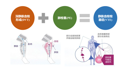 一例術(shù)后VTE致死引發(fā)的醫(yī)療糾紛