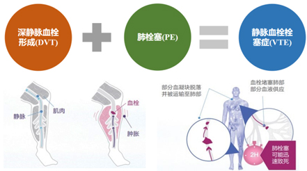 躺著也能防血栓？神經(jīng)肌肉電刺激來(lái)幫忙