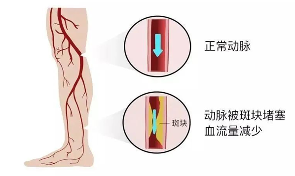 血栓是心梗、腦梗的元兇，很容易找上這些人