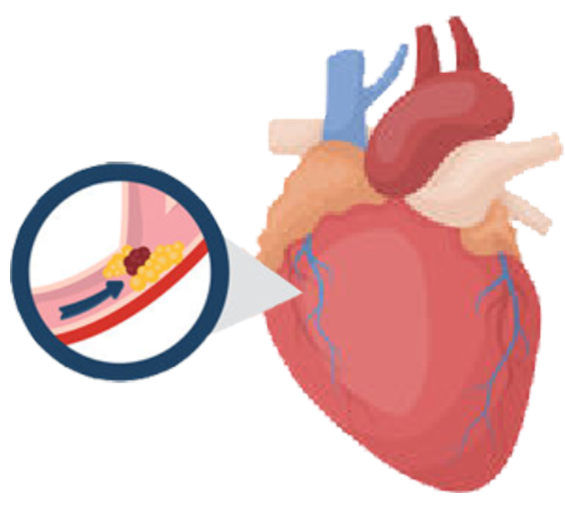 血栓是心梗、腦梗的元兇，很容易找上這些人
