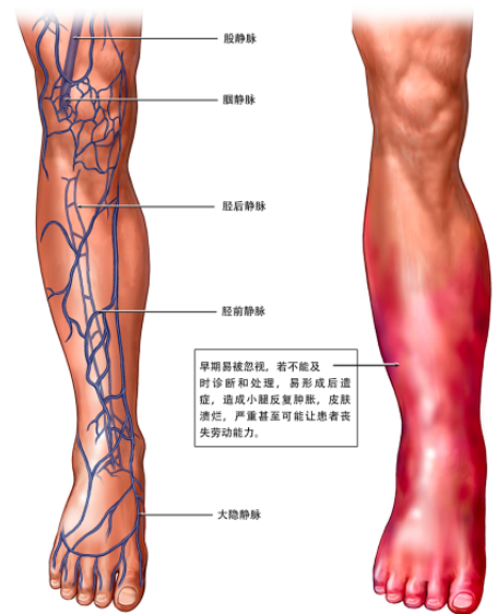 警惕！這個(gè)全球“第三大心血管殺手”，我們該如何應(yīng)對？