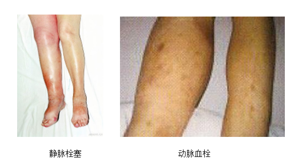 動(dòng)脈血栓和靜脈血栓有什么區(qū)別嗎？