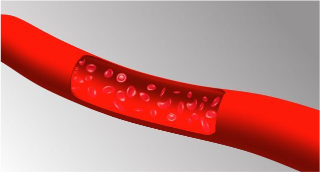 老年人如何預(yù)防下肢靜脈血栓 哪些癥狀提示下肢靜脈有血栓了