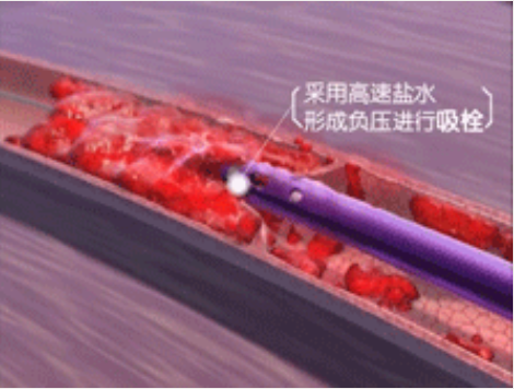 深靜脈血栓能致命，防治“大法”要了解！