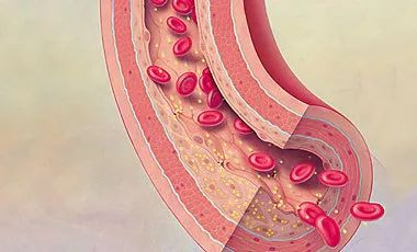 血栓形成，三個(gè)要素細(xì)分說